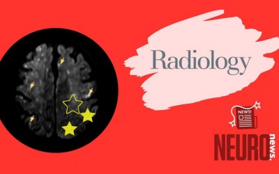 MRI of Cerebral Fat Embolism: Type 1 Starfield Pattern