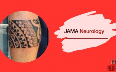 Tattoo Reaction—a Diagnostic Clue in Neurosarcoidosis
