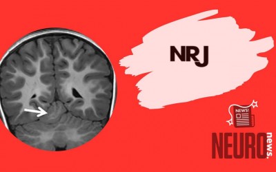 Neuroimaging Features of Ectopic Cerebellar Tissue: A Case Series Study of a Rare Entity