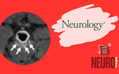 Teaching NeuroImages: High-resolution MRI before and during a sentinel headache demonstrates aneurysm wall hemorrhage