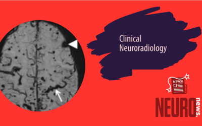 Cerebral Superficial Siderosis: Etiology, Neuroradiological Features and Clinical Findings
