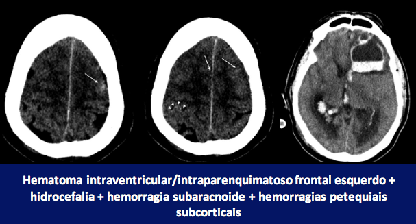 Achados de neuroimagem no COVID-19